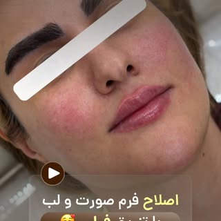 ✨ زیبایی یعنی حفظ تناسب، نه تغییر چهره.

در کلینیک ما، قبل از هر تزریق، فرم صورت شما به‌صورت تخصصی ب