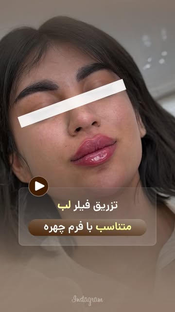 ⁨	⁨	✨ تزریق فیلر لب متناسب با فرم چهره شما✨

هر چهره‌ای منحصربه‌فرده و فیلر لب باید با تناسبات طبیعی