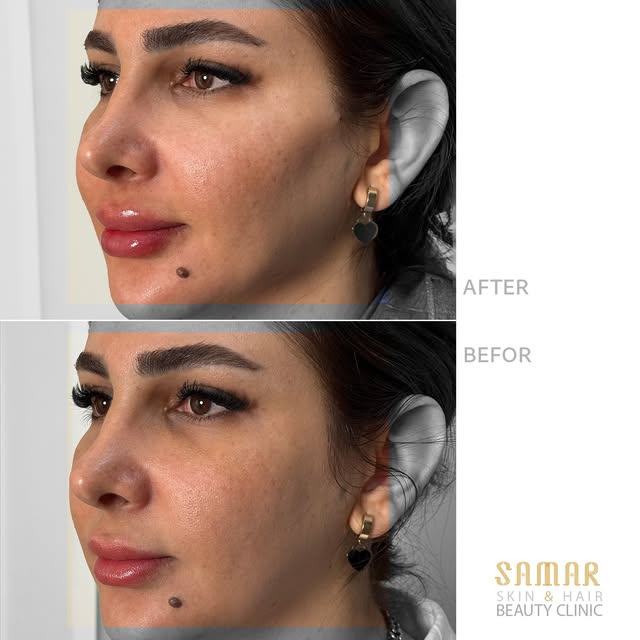 سه تغییر ظریف، یک نتیجه هماهنگ‌تر. ✨

▫️ فیلر گونه به روش فشن
▫️ تمدید فیلر لب
▫️ فیلر چانه

نتیجه ر