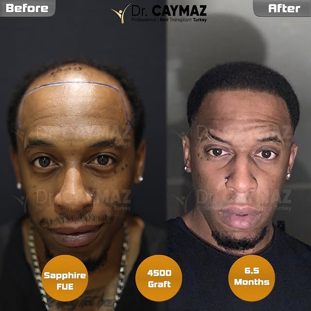 @toofine__ 6,5 Months Result / 4500 Graft / Dr.Caymaz
 .
📞📱
.
🇬🇧🇪🇸🇫🇷🇸🇦🇺🇸🇮🇹

Dr.Erkam C