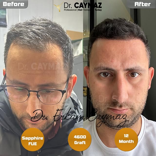 Amazing Result - 4600 Graft - 12 Month by Dr.Caymaz

✨ **Transform Your Look with Istanbul’s Hair Re