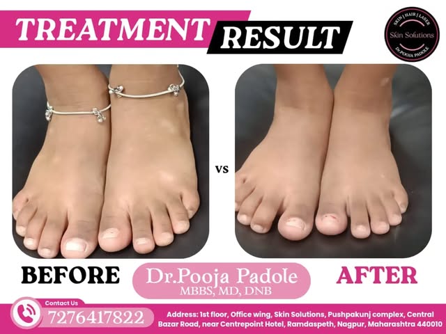 ✨ Progress takes patience, but every step counts.

From visible VITILIGO spots to significant repigm