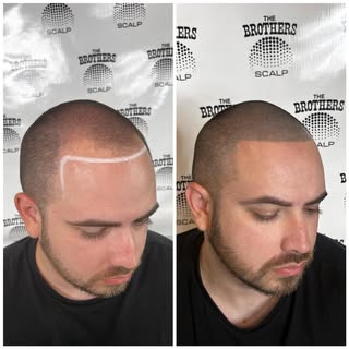 Come renew your image at BroScalp! In only 2 sessions you can get a rejuvenated, natural hairline th