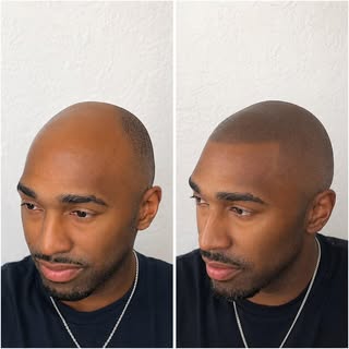 We recreates the appearance of natural hair follicles to restore a defined hairline and the look of 