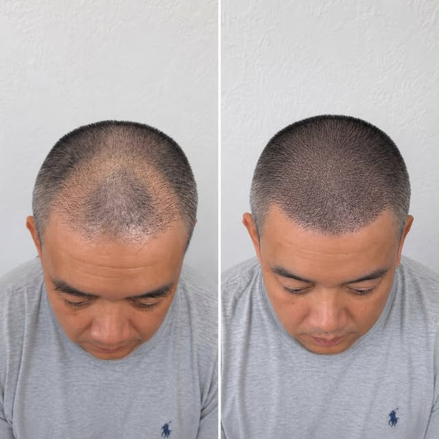 This before-and-after shows how scalp micropigmentation can:

✔️ Visually conceal areas of low densi