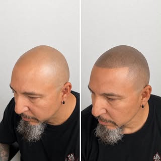 Houston check out this transformation In just a 2/3 sessions, we restored your hairline your density