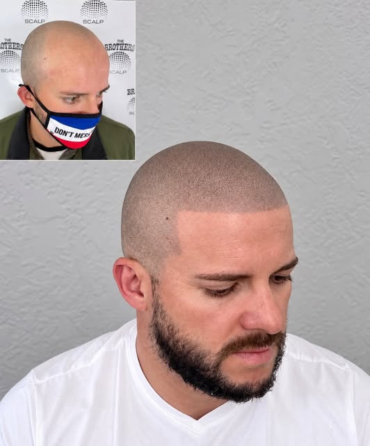 With scalp Micropigmentation (SMP), we visually recreate thousands of follicles using tiny dots, car