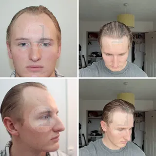 Hair transplant/ Greffe capillaire 
Male / Homme 
@drmwambapatrick
