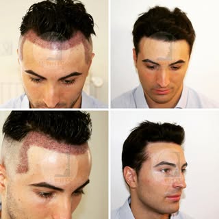 AGA - Male
Hair transplant - Mesotherapy
Natural hair line
@drmwambapatrick - Brussels & Kinshasa
Co