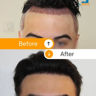 A natural-looking hairline is not created by adding more grafts. It is created through careful plann