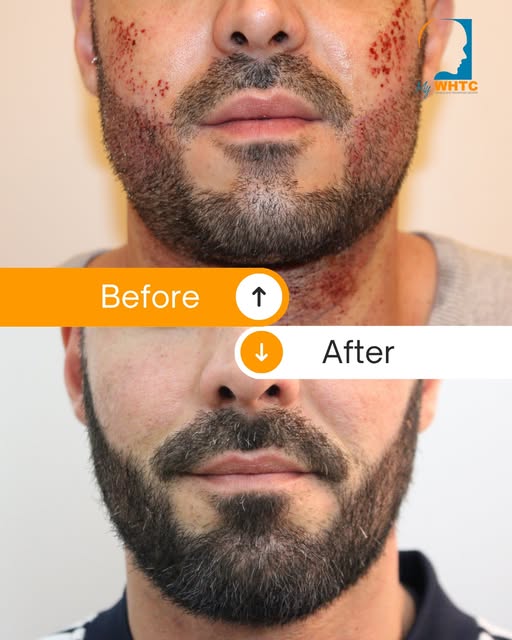 This before-and-after transformation shows the progression from the early post-procedure stage to a 