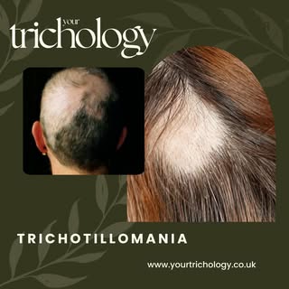 A trichologist can be a valuable part of the recovery process for those dealing with trichotillomani
