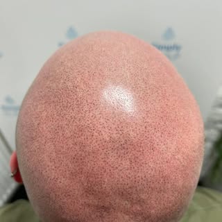 Dotty loveliness! #scalpmicropigmentation #hairtattooing #goodbyebaldness #surreyhair #londonhair #n