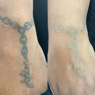 Removal on darker skin tones can be tricky, but as long as my clients are aware of the increased ris