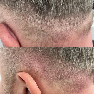 First session scar camouflage whose hairloss journey started over 30 years ago!! This will cover so 