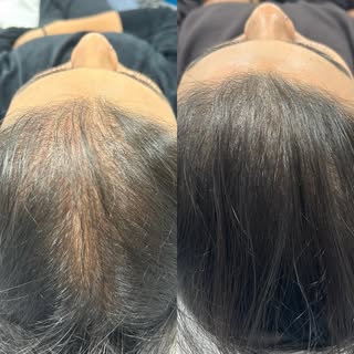 Before and after 2nd session for this lovely lady!  This is a healed result and I’m so happy with th