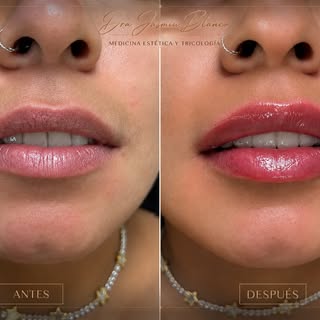 ✨ Rejuvenecer no significa cambiar tus labios, sino devolverles armonía, hidratación y frescura.

Es