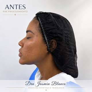 ✨ ANTES Y DESPUÉS | ENDOLÁSER FACIAL ✨

No se trata de cambiar tus facciones, sino de mejorar la cal