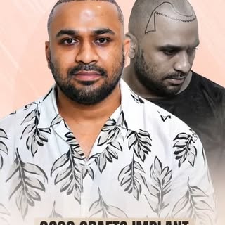 ✨ Hair transplant surgery successfully completed at New Roots.
Location: Kolkata
Grafts: 3200 grafts