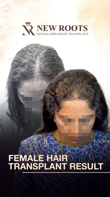 9 months later… and this hairline looks so natural. 👀✨

Female hair transplant in Mumbai, and the g