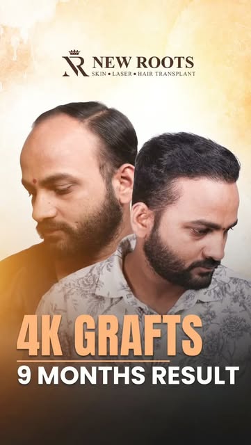9 months. 4000 grafts. And the difference is amazing. 👀🔥

Grade 5 baldness → a brilliant, natural-