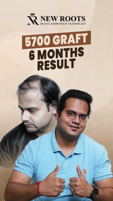 6 months later… and the hairline is looking so natural. 👀🔥

5700 grafts implanted in Kolkata, and 