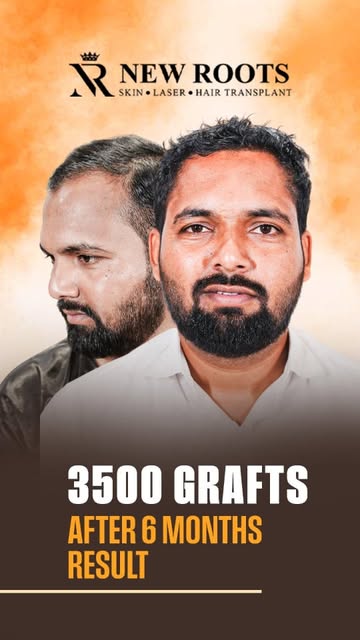 6 months later… and this hairline is looking 🔥

Grade 3 + crown baldness → 3500 grafts in Pune.

Na