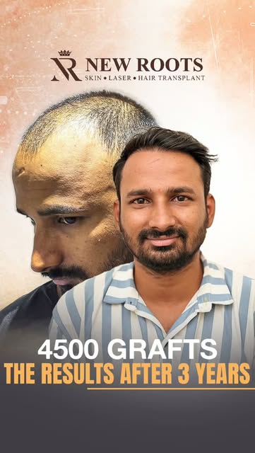 3 years later… and the results still look so good. 👀🔥

Grade 5 baldness → 4500 grafts → 3-year res