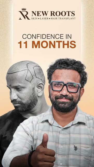 11 months later… and the growth is looking so good. 👀🔥

Grade 5 baldness, with 4000 grafts implant