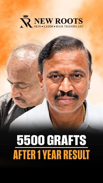 61 years old, Grade 7 baldness, and 5500 grafts implanted in Navi Mumbai. 👀🔥

This was a challengi
