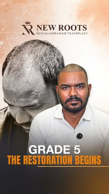 First head wash after the transplant… and the journey has officially begun. 👀🔥

Grade 5 baldness, 