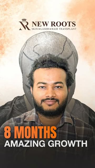 8 months later… and the growth is looking really good. 👀🔥

Grade 6 baldness, 5700 grafts implanted