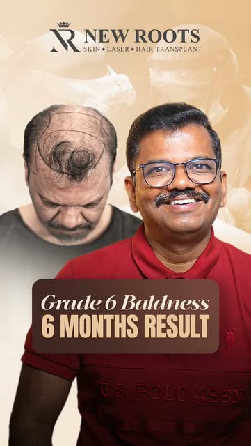 6 months later… and the coverage is looking really good. 👀🔥

46 years old, Grade 6 baldness, and 6