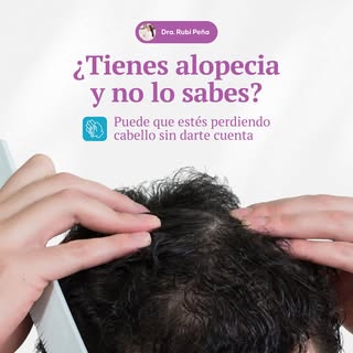 La caída excesiva del cabello puede ser señal de algun tipo de alopecia. Detectarla a tiempo puede m