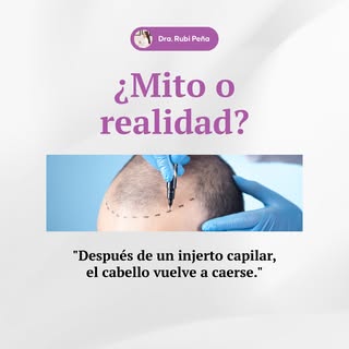 No todo lo que escuchamos sobre el injerto capilar es cierto.

Hoy pusimos a prueba uno de los mitos