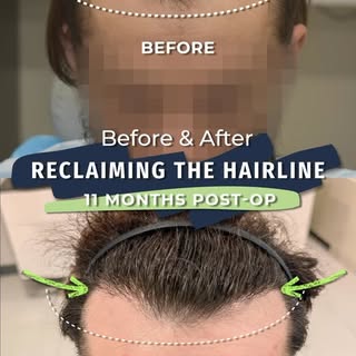 Some transformations aren’t about adding more hair.

They’re about changing the way the entire face 