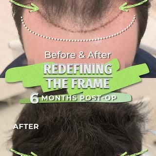 A well-designed hair transplant starts long before the first graft is placed.

For this patient, we 