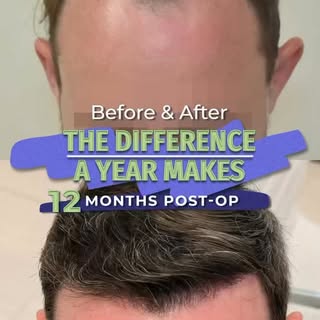 One year. One transformation. One restored hairline.

These before and after results showcase what’s