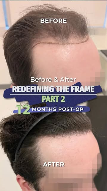 3,213 grafts. A fully balanced and reframed facial frame.

This FUE hair transplant focused on creat