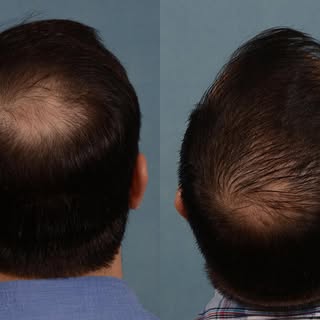 Let’s regrow your hair! Book your hair restoration consultation to learn more about FUE!
