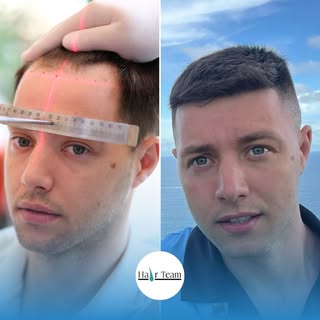 ⭐ Erfolgsgeschichte einer unrasierten Haartransplantation

Wischen Sie, um die beeindruckende Verwan