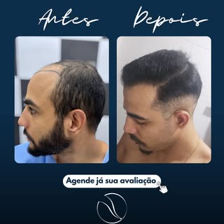 Esse paciente chegou até nós com uma calvície já bastante avançada, com uma área grande sem cobertur
