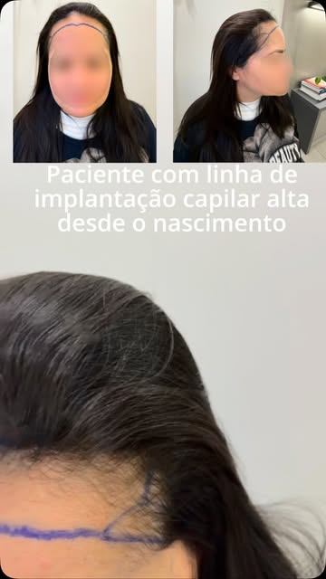#transplantecapilar #transplantecapilarfue #hairtransplant #transplantecapilarfeminino #campinas
