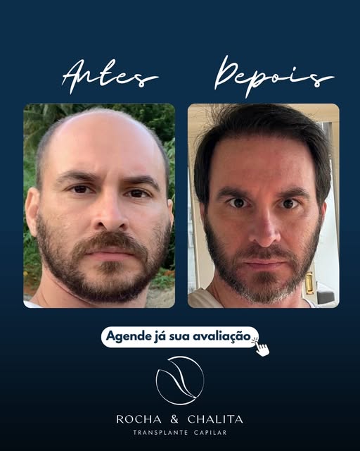 Antes e depois dessa transformação com 10 meses de evolução. 

A primeira etapa desse processo foi i