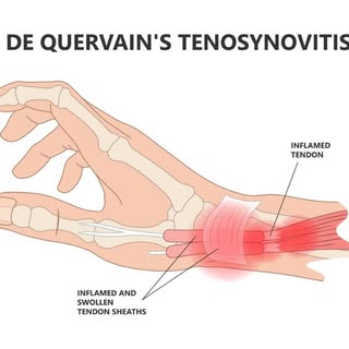 Wrist Tendinitis & De Quervain’s Tenosynovitis Treatment Birmingham & Warwickshire
-
https://www.dyn