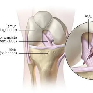 ACL injury treatment and rehabilitation 
👇🏼
https://www.dynamicregenmedicine.co.uk/post/anterior-c