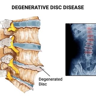Delay Spinal Arthritis - Pure platelet-rich plasma delays spinal disc degeneration by activating SIR