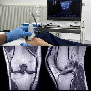 🧬🦵 MRI Evidence Grows for PRP in Knee Osteoarthritis, specifically in regards to cartilage and bon