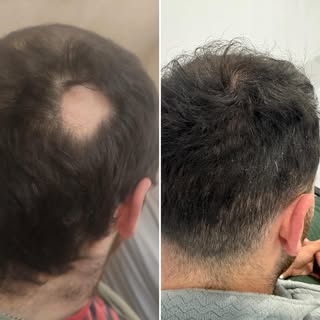 ✨ Alopecia Areata – Real Transformation ✨
We’re excited to share incredible progress from a recent p