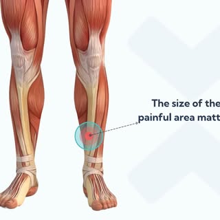 🏃‍♂️ Struggling with Shin Splints (Periostitis)?
Don’t let pain hold you back! At Dynamic Regenerat